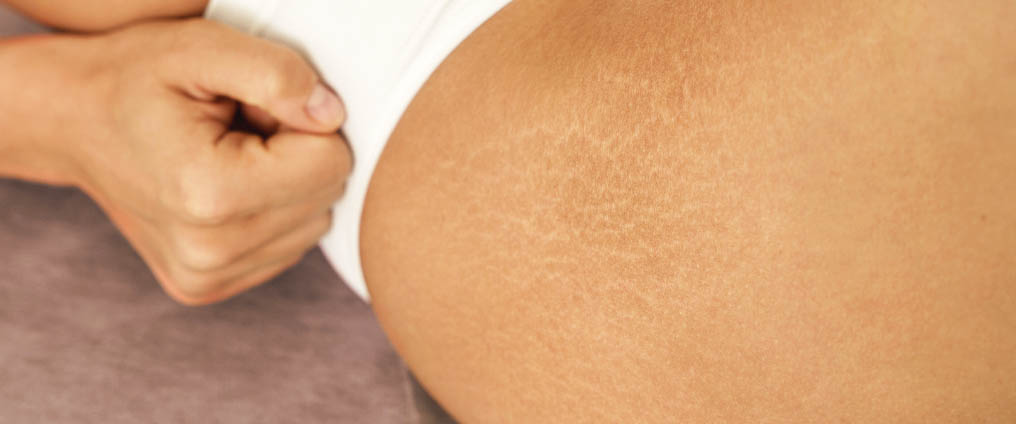 Prevenire e rimuovere le smagliature