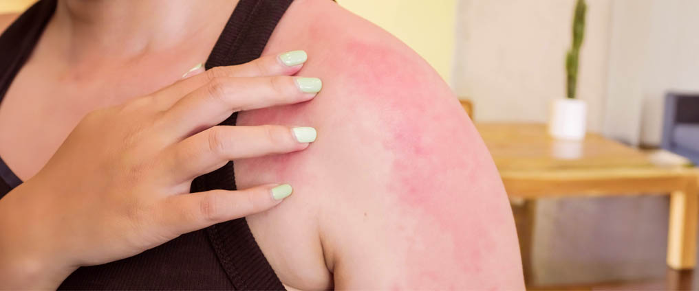 Allergia al sole: sintomi e rimedi