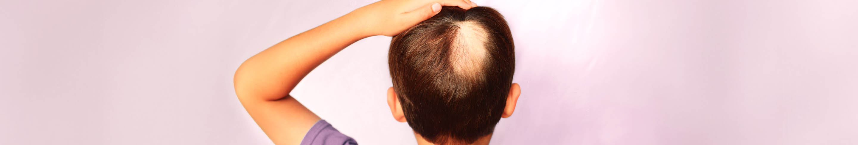 Alopecia areata