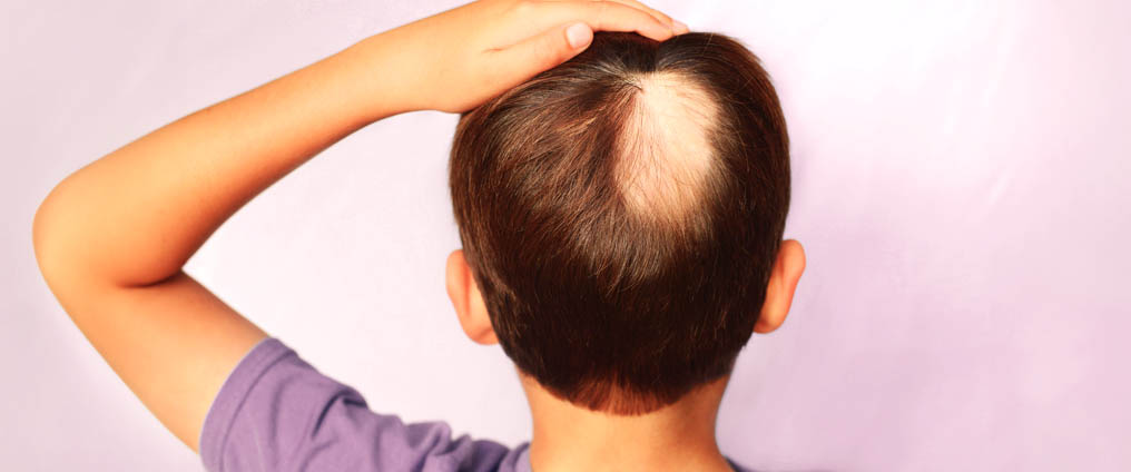 Alopecia areata: cause e trattamento 