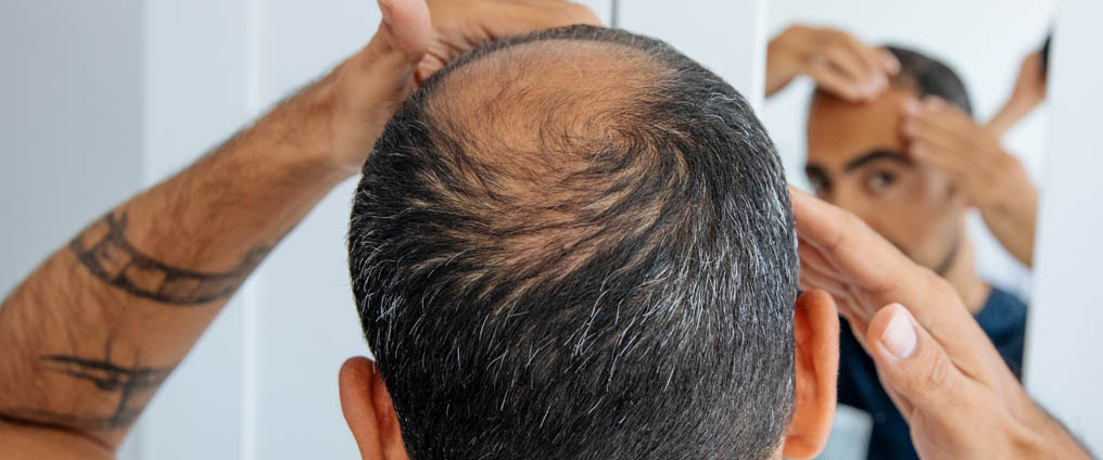 Riconoscere l’alopecia e fermarla in tempo