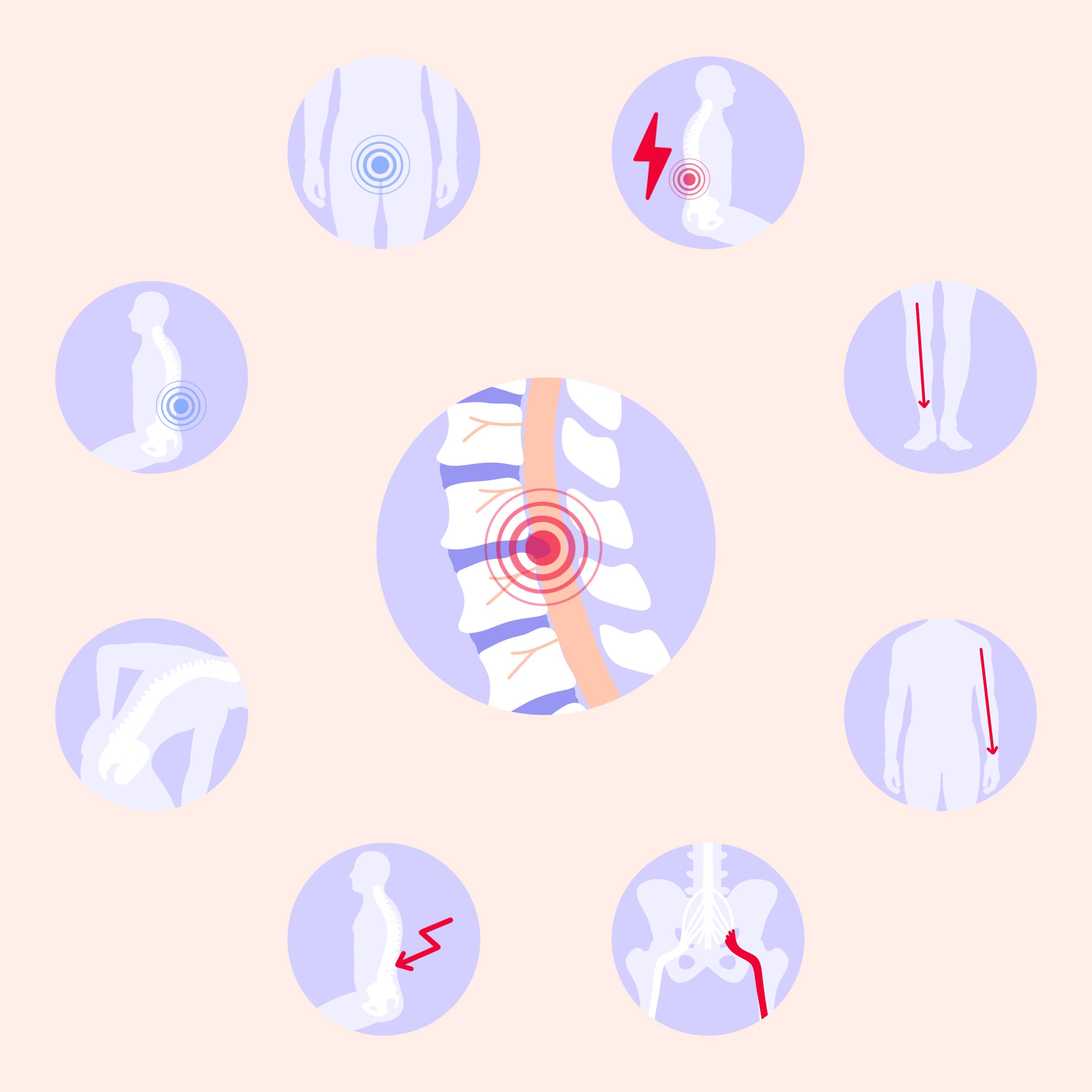 ernia del disco sintomi