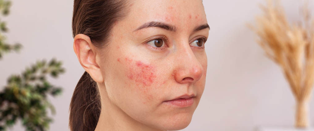 Rosacea: sintomi e trattamento