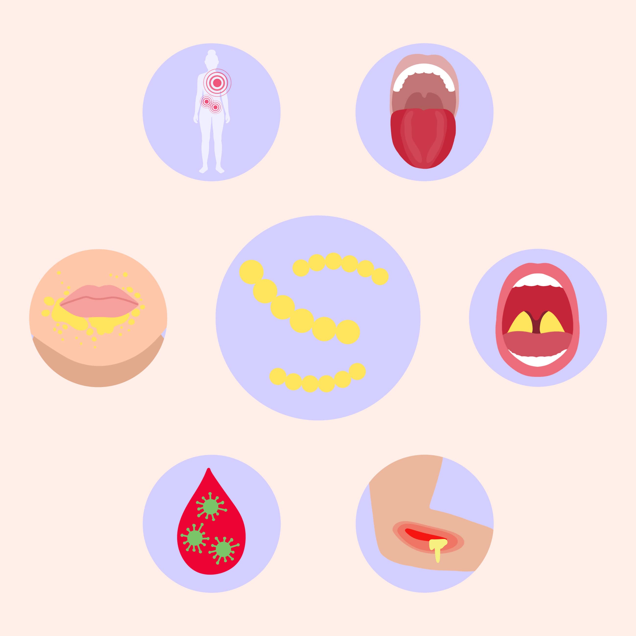 infezione streprococcica