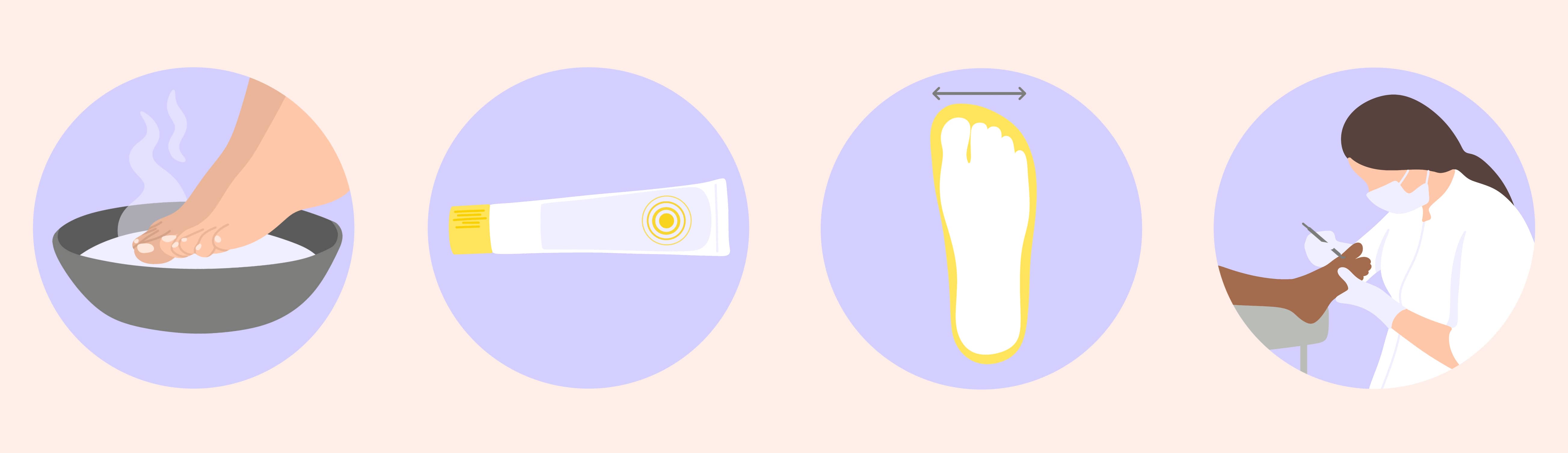 unghia incarnita cosa fare