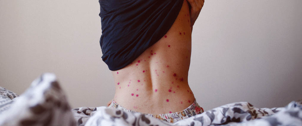 Varicella: sintomi, vaccinazione e contagio